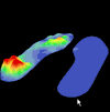 Распределение давления между стопой и поверхностью в программе «ДиаСлед-М». 3D режим